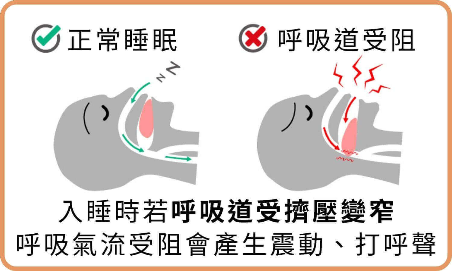 睡眠呼吸中止症是什麼？發生原因、症狀及改善方法？