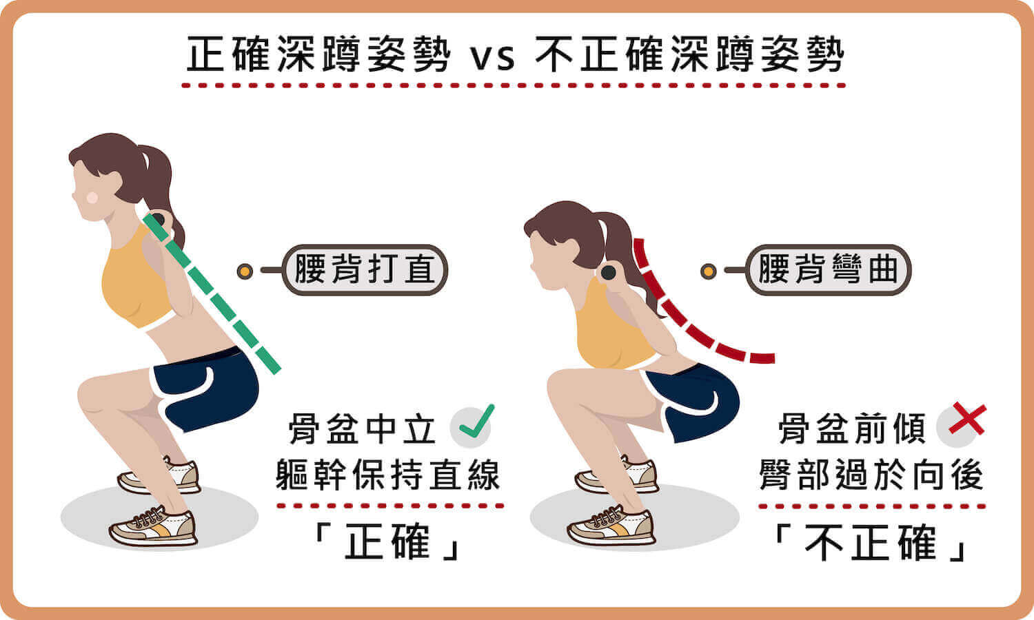 骨盆前傾原因、症狀與推薦床墊？如何改善睡覺腰部懸空腰痛？