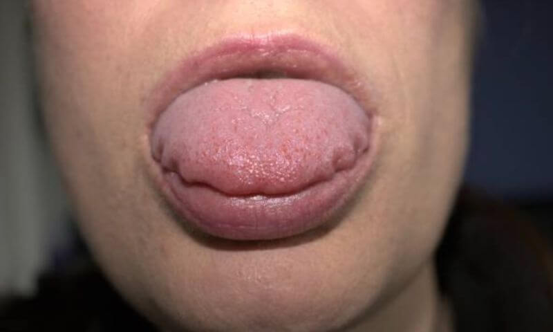 03睡醒時舌頭有明顯的牙印齒痕，是睡覺磨牙的徵兆