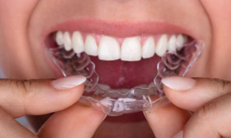 05護牙套(咬合板)可保護牙齒損害、幫助戒掉睡覺磨牙