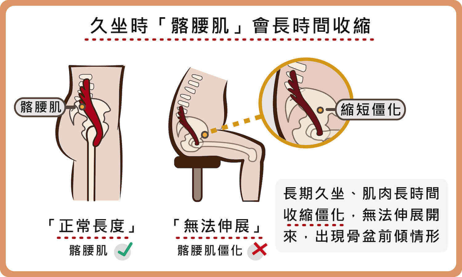 久坐導致髂腰肌長時間收縮肌肉僵化
