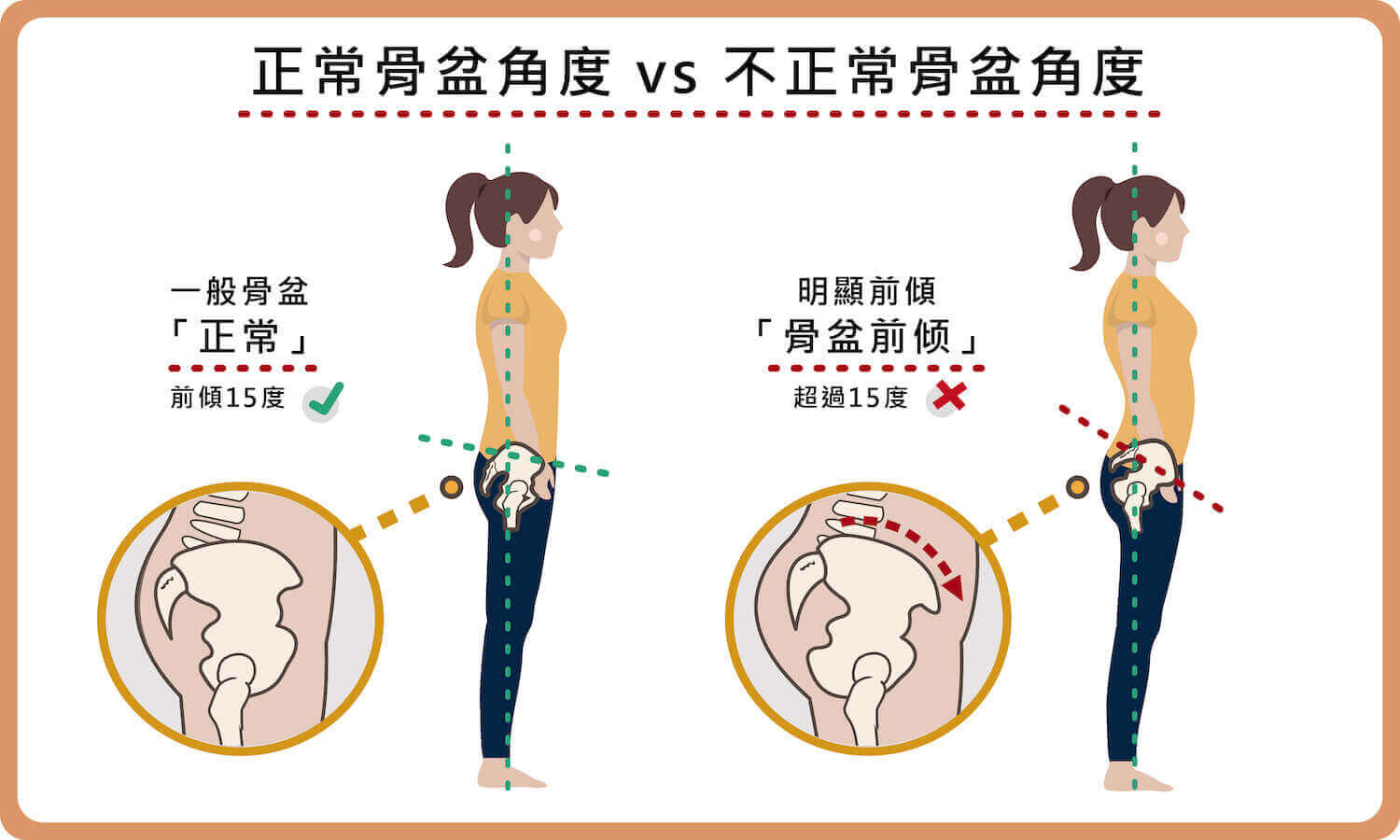 正常骨盆角度vs不正常骨盆角度