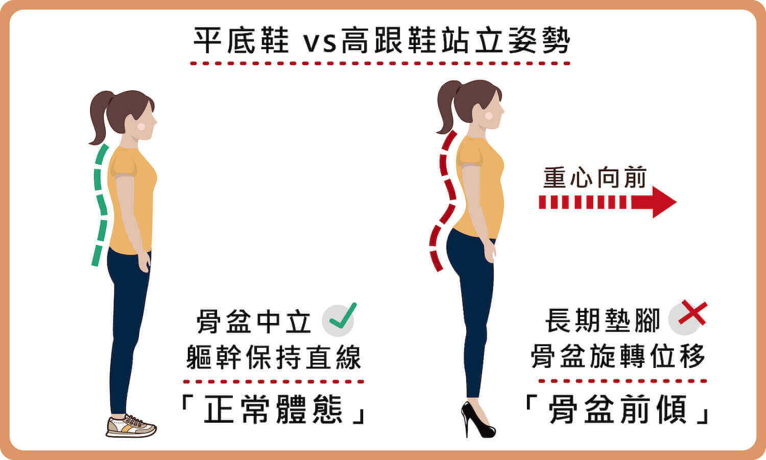 穿著高跟鞋時踮腳尖姿勢會讓身體重心向前轉移，為了維持身體平衡，骨盆會旋轉位移，長期下來導致骨盆前傾