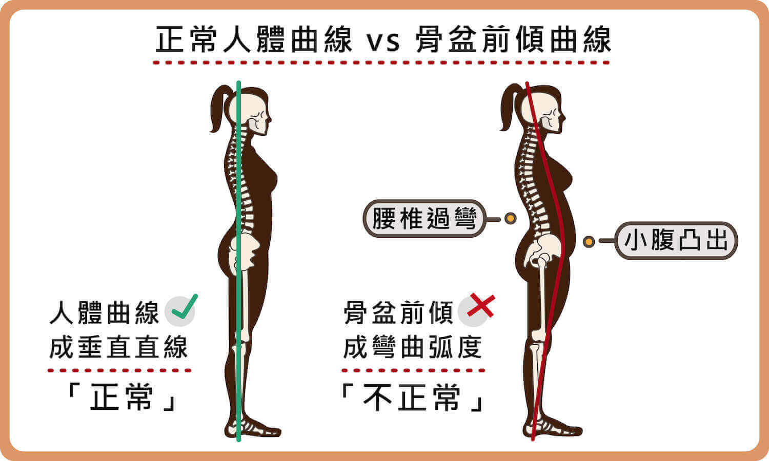 腰椎過彎導致小腹突出、臀部不正常後翹