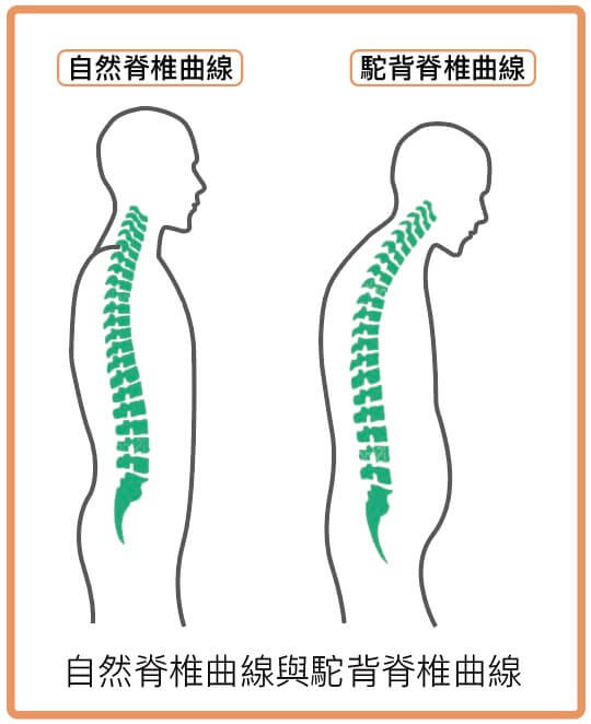 自然脊椎曲線與駝背脊椎曲線