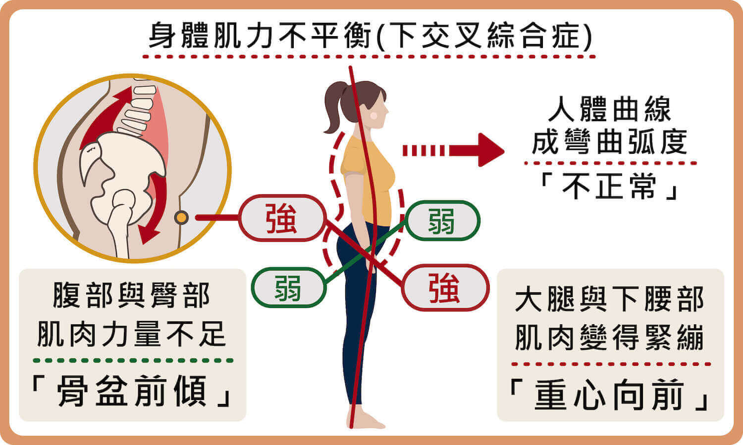 身體肌力不平衡(也稱下交叉綜合症)使重心向前、骨盆前傾