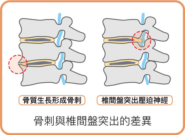 骨刺與椎間盤突出的差異